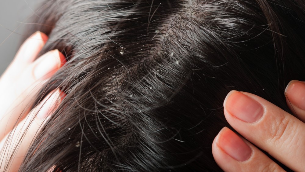 Dandruff Q&A: Causes & Treatments