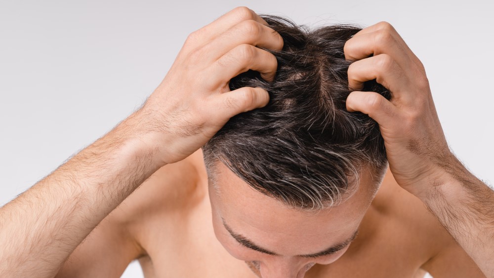 21 Best ways to Cure Male Pattern Baldness Naturally  AHS India