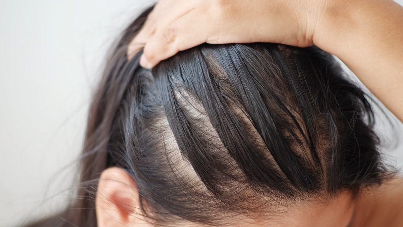 Hair Loss During Pregnancy  Causes and Cures  The Moms Co