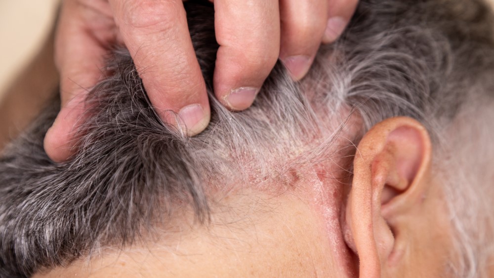 Scalp Psoriasis Treatment Options