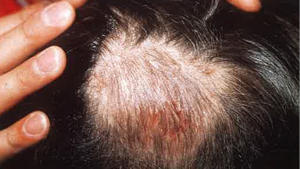 Fungus On Scalp