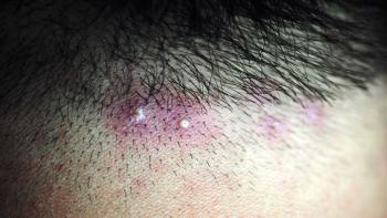 Folliculitis