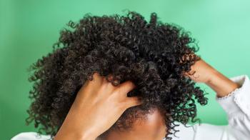 Dandruff: What is it and how do you treat it?