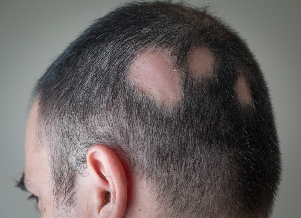 Understanding Alopecia Areata Hair Loss Treatments Philip